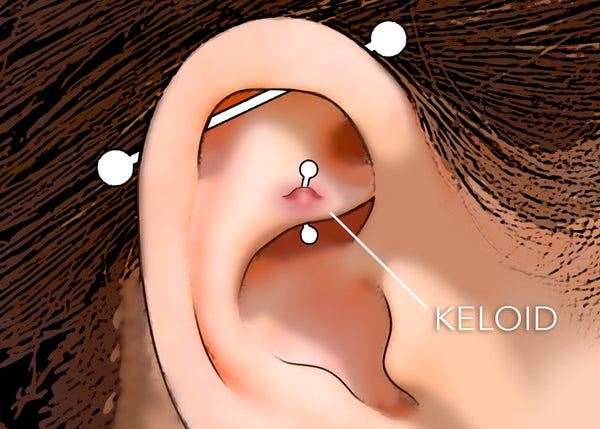 is-it-a-keloid-or-an-irritation-bump-worldwide-tattoo-piercing-blog